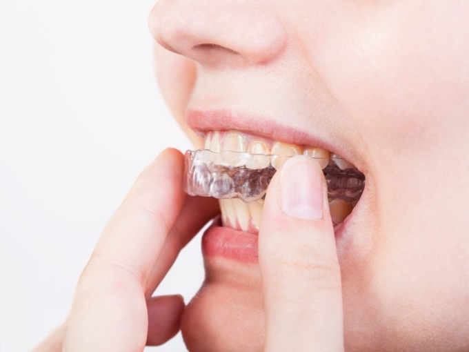 Rimedi contro il bruxismo ecco il bite dentale