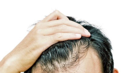 Caduta dei capelli nell’uomo, perché accade e come si risolve