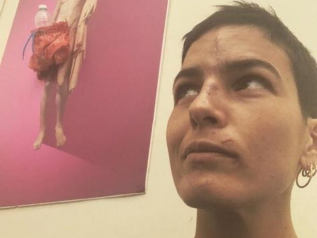 Ex Miss Italia dopo l’incidente mostra le cicatrici su Instagram