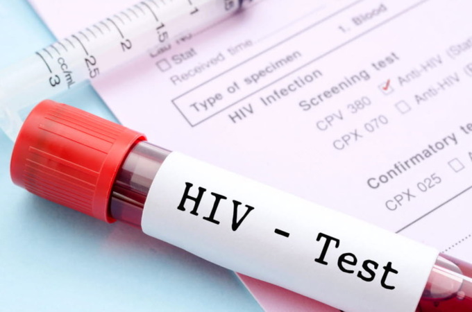 HIV e AIDS, le nuove diagnosi in Italia nel 2020