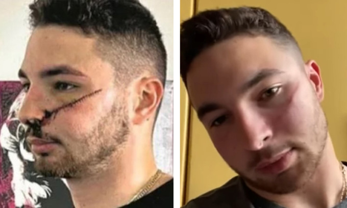 Rider sfregiato per aver difeso una ragazza, l’Inail riconosce l’infortunio sul lavoro