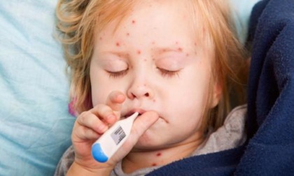 Casi  aumentati del 79% e vaccinazioni mancate: torna l'allarme morbillo
