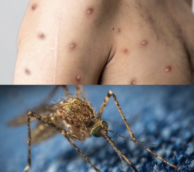 Schizzano i contagi: in Emilia Romagna il vaiolo delle scimmie, in Veneto il West Nile
