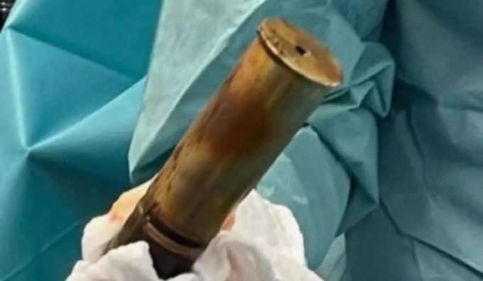 “Dottore, ho una bomba nel retto”: ospedale evacuato per estrarre l’ordigno da un vizioso 88enne