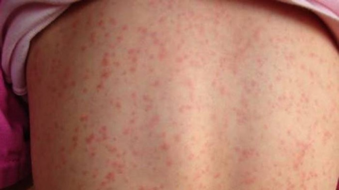 Scarlattina nei bambini (anche in forma leggera e senza esantema): sintomi e come curare la malattia