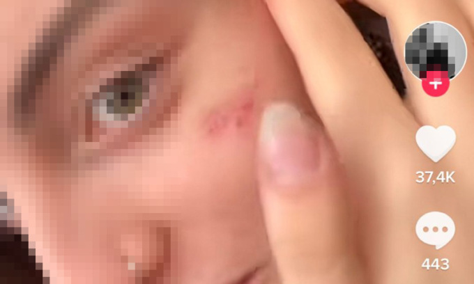 “Cicatrice francese”, cosa è la nuova pericolosa challenge su Tiktok