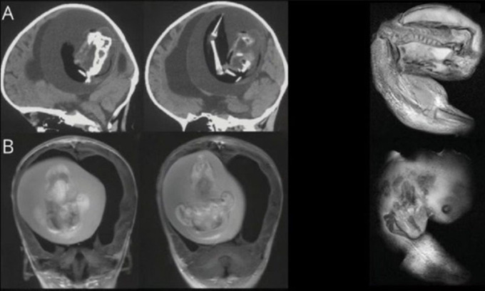 Dal cranio di una bimba di un anno rimosso il feto del gemello “parassita”