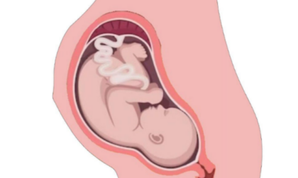 Gravidanza con l'utero in una grande ernia fuori dall'addome: mamma e bimba salve grazie a un intervento eccezionale