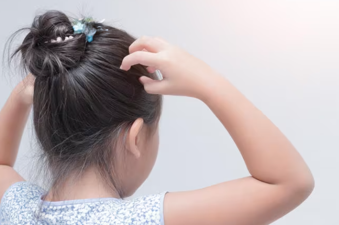 Mamma vegana non vuole debellare i pidocchi della figlia: “Non uccido esseri viventi”