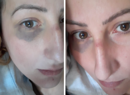 Cerca di uccidere il fidanzato per 3 volte di fila: pochi mesi fa pubblicava sui social foto con i lividi accusando l’ex