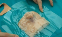 Bambino nato senza naso: glielo ricostruiscono "copiando" quello del gemello