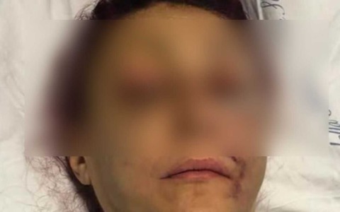 Ha picchiato la ex fino a farle perdere un occhio, ma non andrà in carcere. I giudici: “Va compreso”